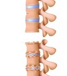 Kakla osteohondrozes rampas
