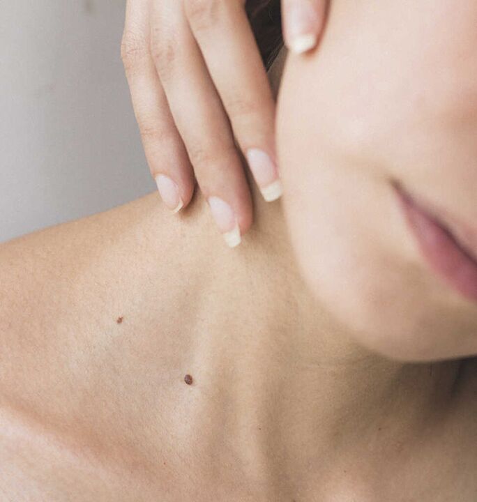 Kakla stīvums ir viens no mugurkaula kakla osteohondrozes sākuma stadijas simptomiem.