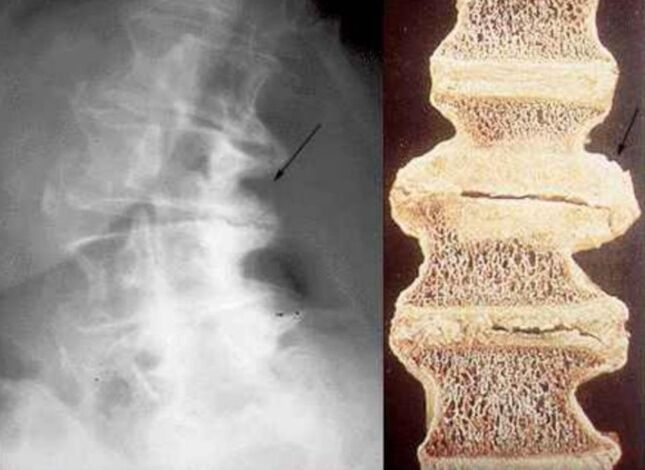 skriemeļu bojājumi krūšu kurvja osteohondrozes gadījumā