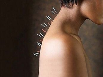 Refleksoterapija ir efektīva dzemdes kakla osteohondrozes ārstēšanas metode